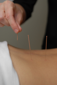 acupuncture arthrite