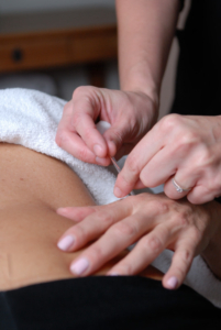 L'acupuncture pour soulager l'épicondylite St-Lambert Rive-Sud