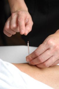 acupuncture pour arrêter de fumer St-Lambert Rive-Sud